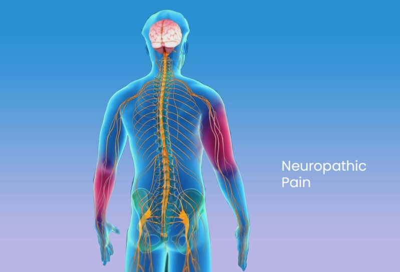 Neuropathic Pain