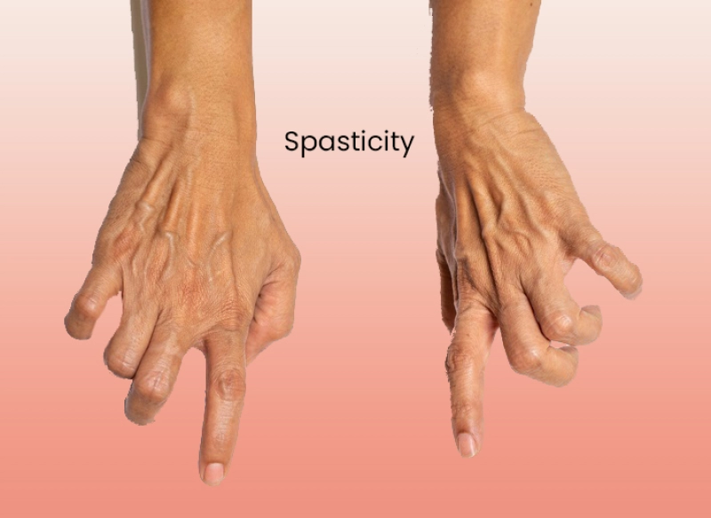 Spasticity